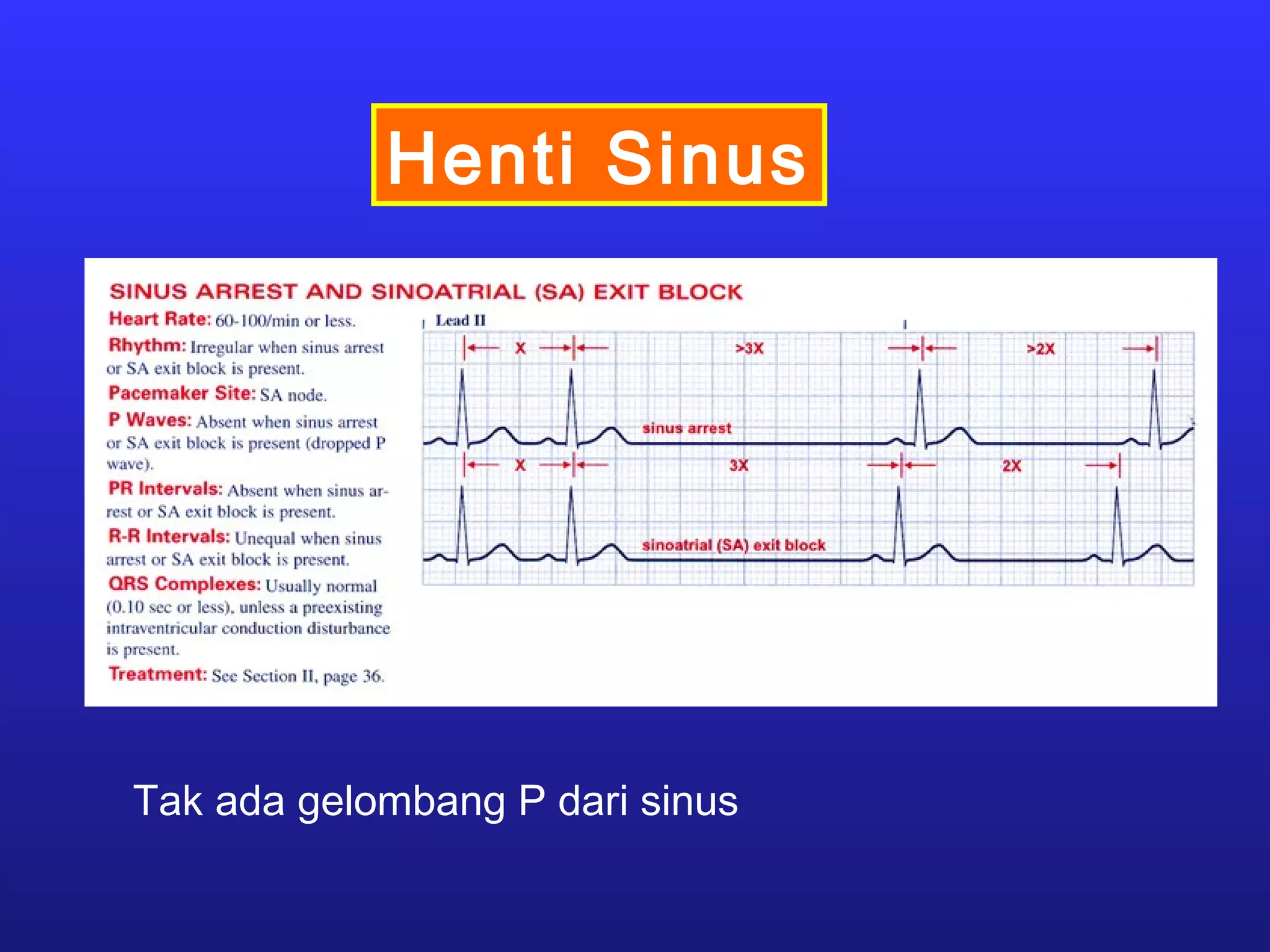 Henti Sinus
Tak ada gelombang P dari sinus
 