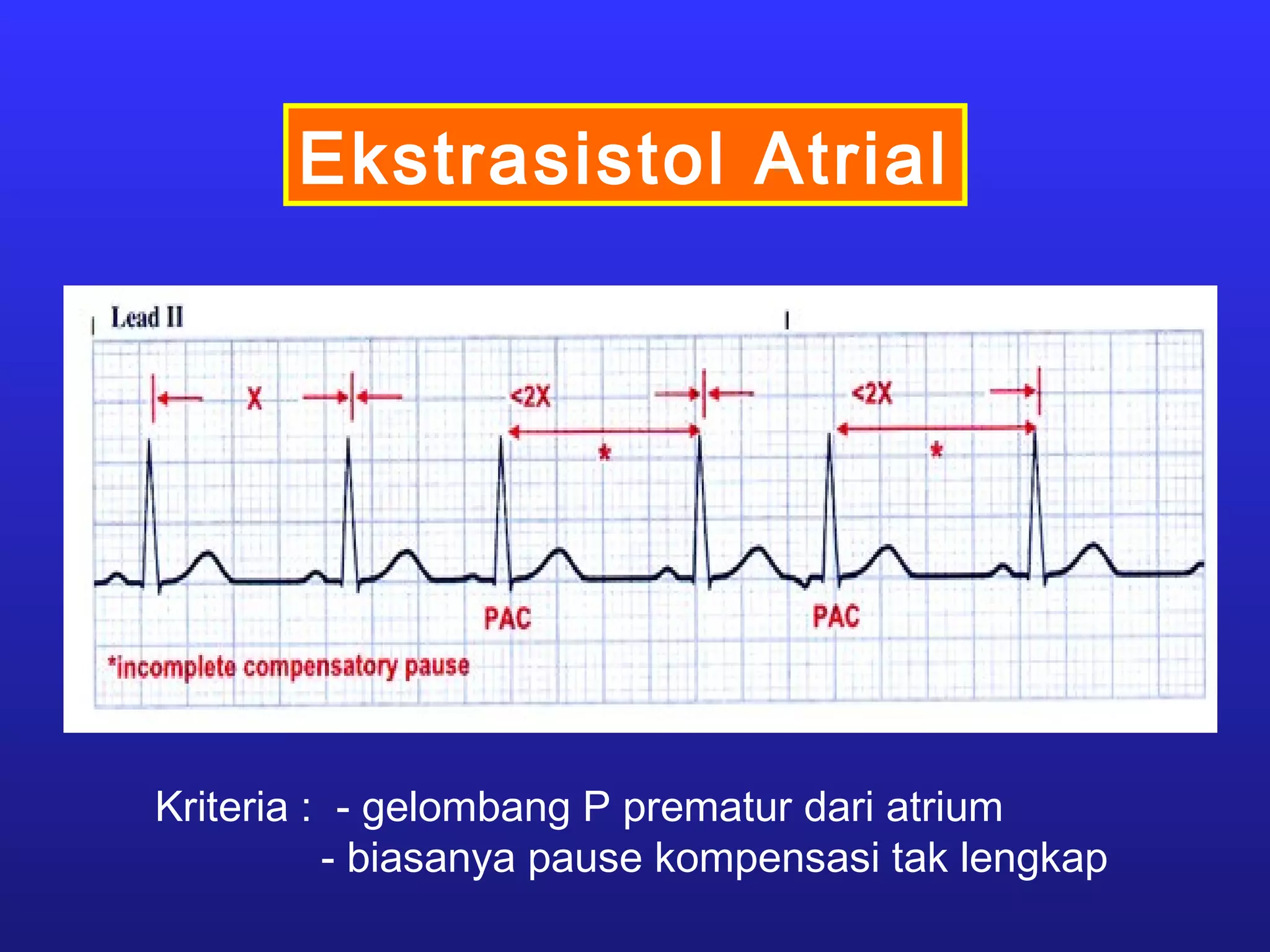 Ekstrasistol Atrial
Kriteria : - gelombang P prematur dari atrium
- biasanya pause kompensasi tak lengkap
 