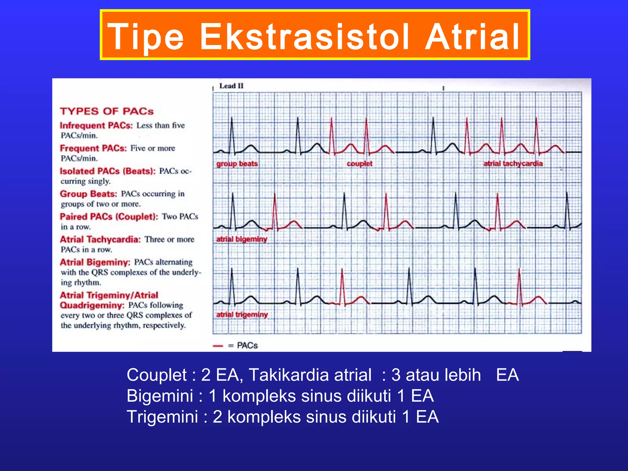 Tipe Ekstrasistol Atrial
Couplet : 2 EA, Takikardia atrial : 3 atau lebih EA
Bigemini : 1 kompleks sinus diikuti 1 EA
Trigemini : 2 kompleks sinus diikuti 1 EA
 