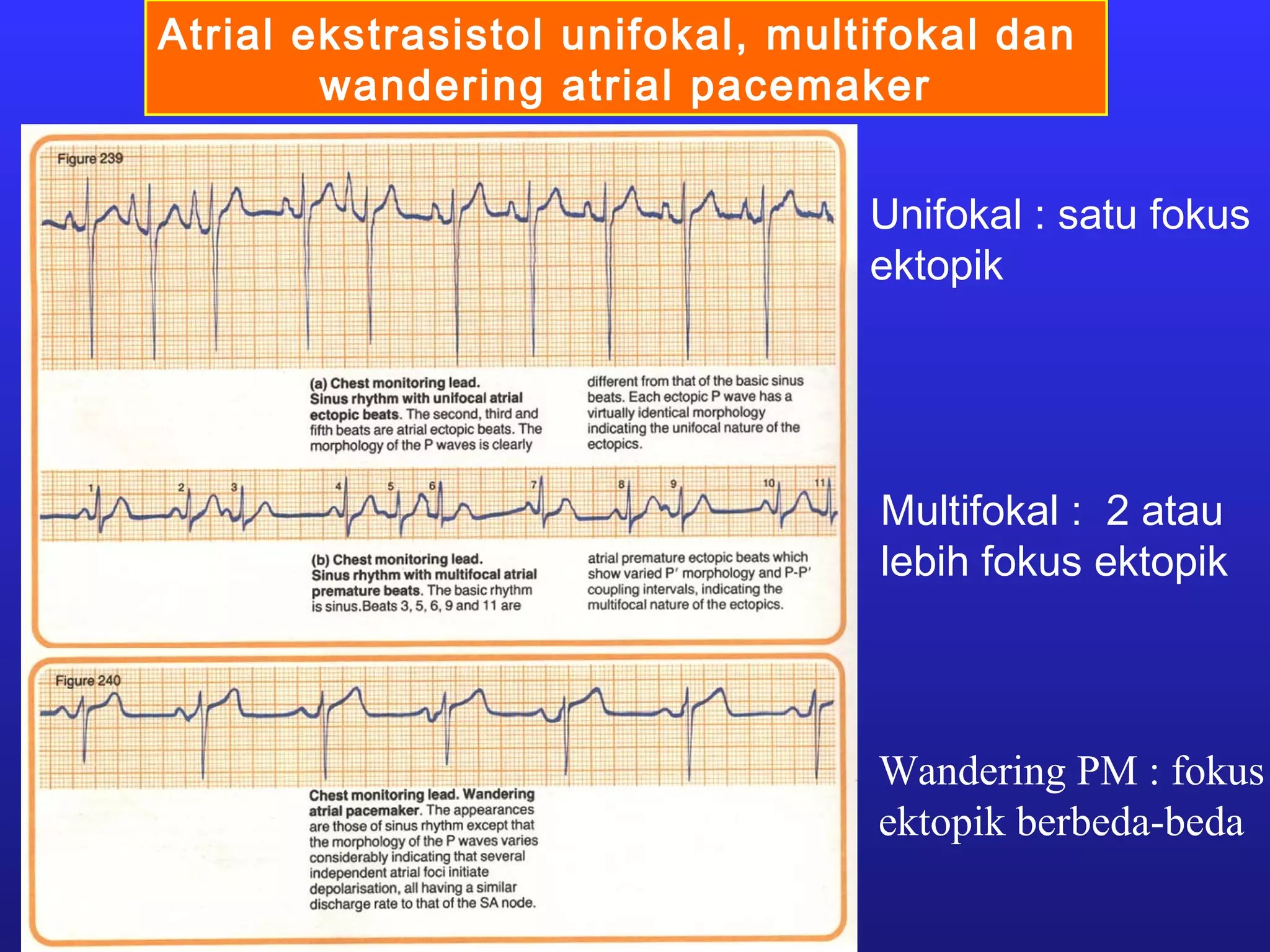 Atrial ekstrasistol unifokal, multifokal dan
wandering atrial pacemaker
Multifokal : 2 atau
lebih fokus ektopik
Unifokal : satu fokus
ektopik
Wandering PM : fokus
ektopik berbeda-beda
 
