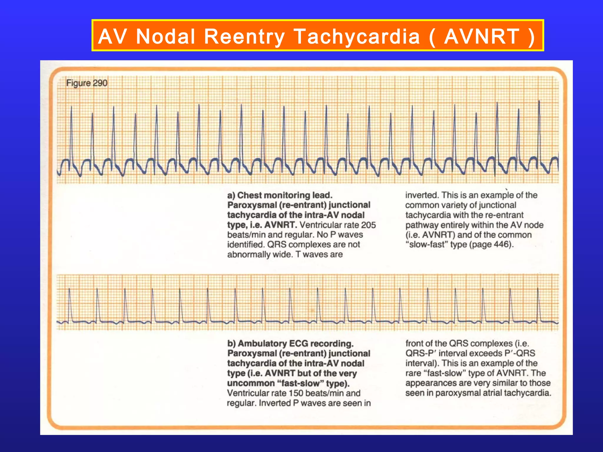 AV Nodal Reentry Tachycardia ( AVNRT )
 
