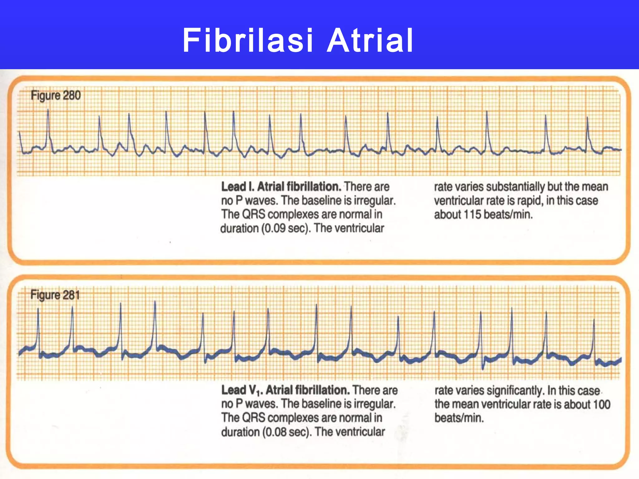 Fibrilasi Atrial
 