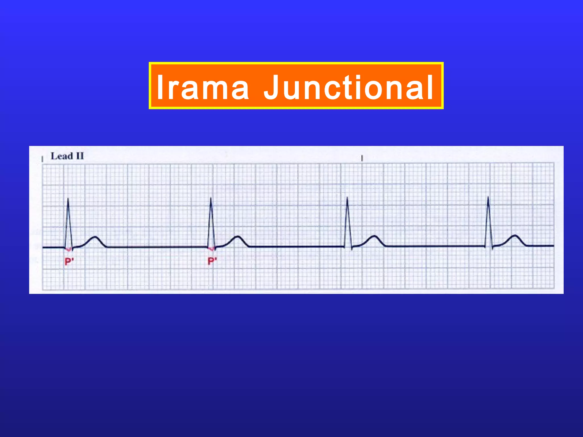 Irama Junctional
 