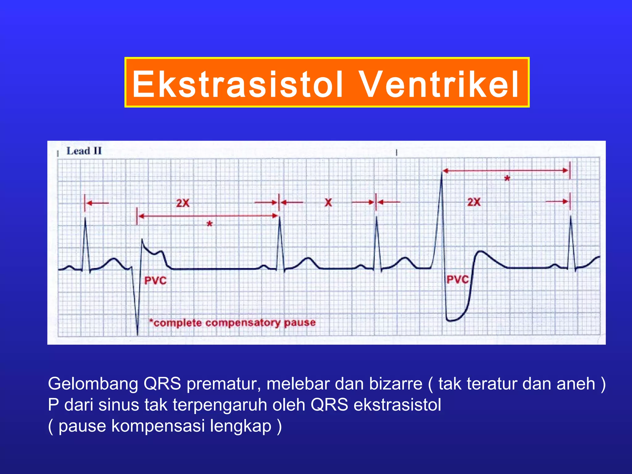 Ekstrasistol Ventrikel
Gelombang QRS prematur, melebar dan bizarre ( tak teratur dan aneh )
P dari sinus tak terpengaruh oleh QRS ekstrasistol
( pause kompensasi lengkap )
 