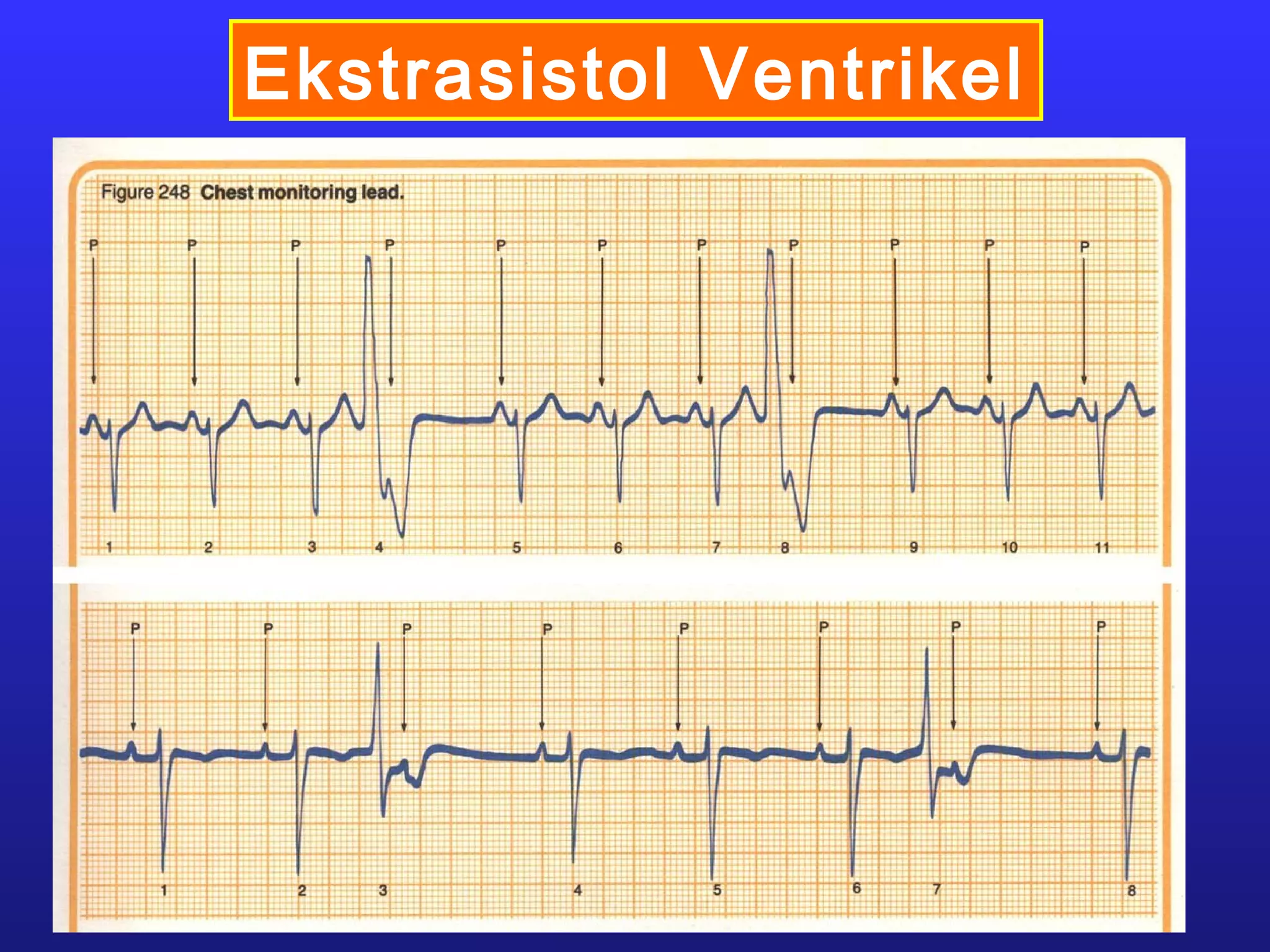 Ekstrasistol Ventrikel
 