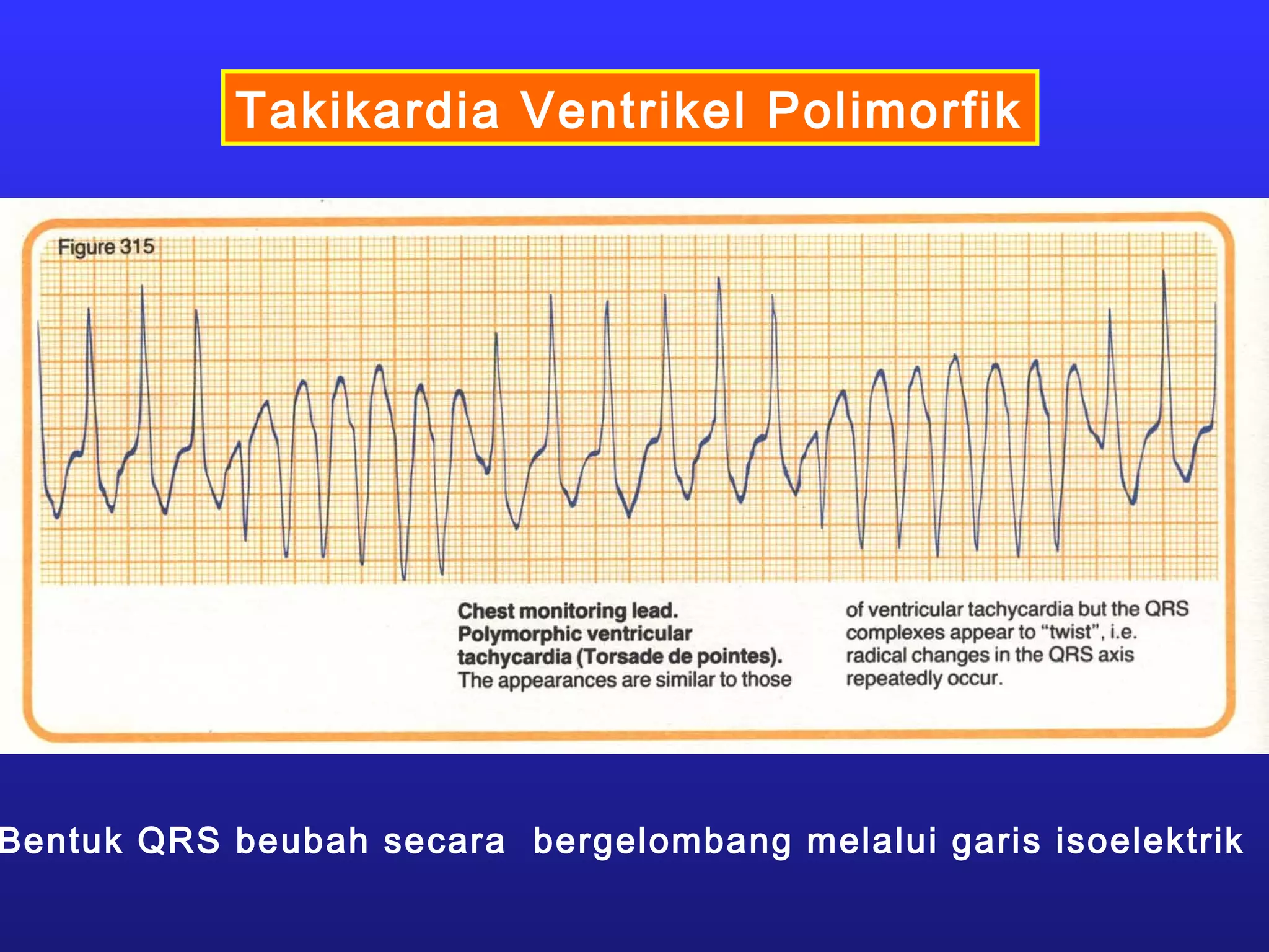 Takikardia Ventrikel Polimorfik
Bentuk QRS beubah secara bergelombang melalui garis isoelektrik
 
