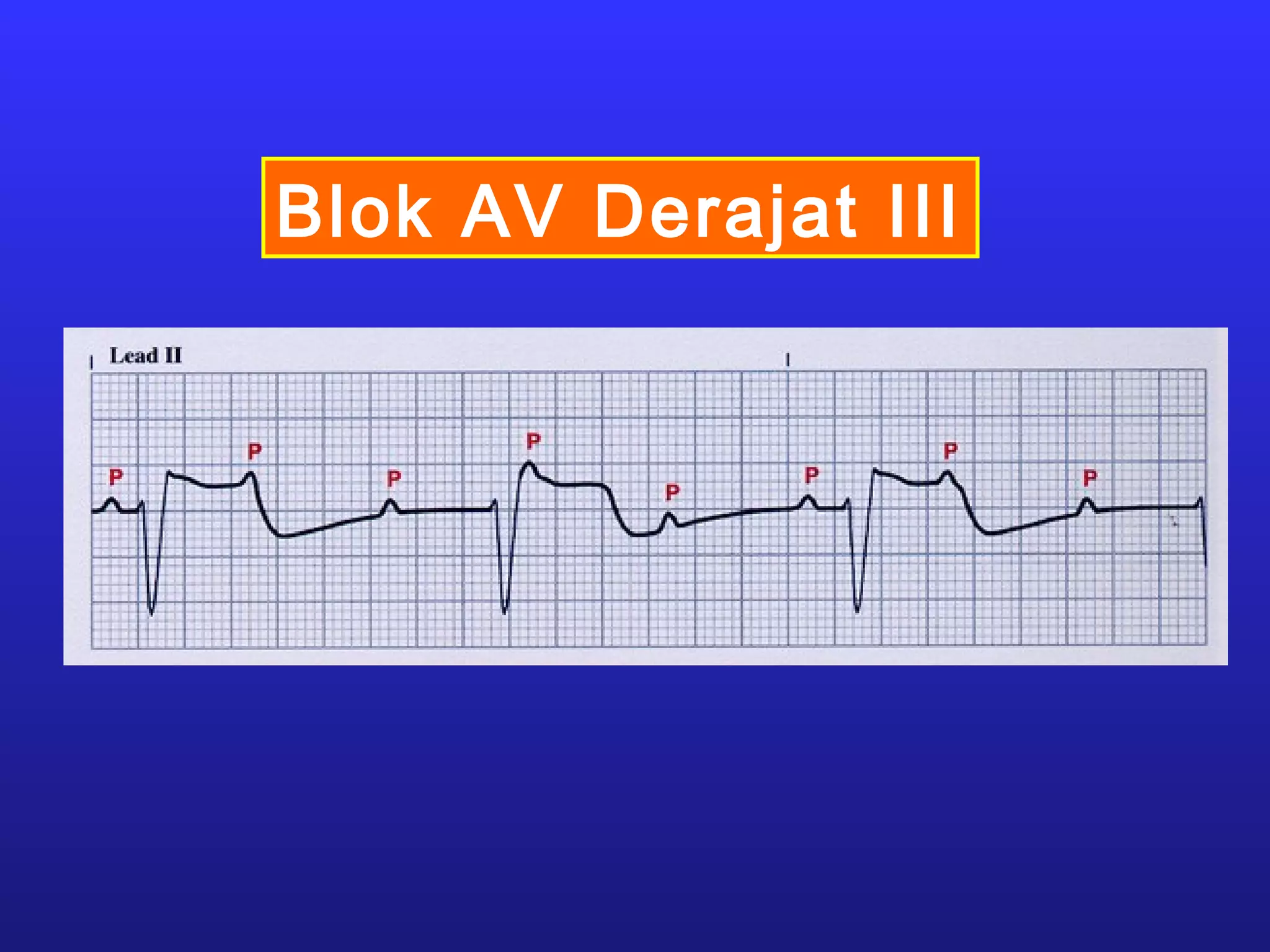Blok AV Derajat III
 