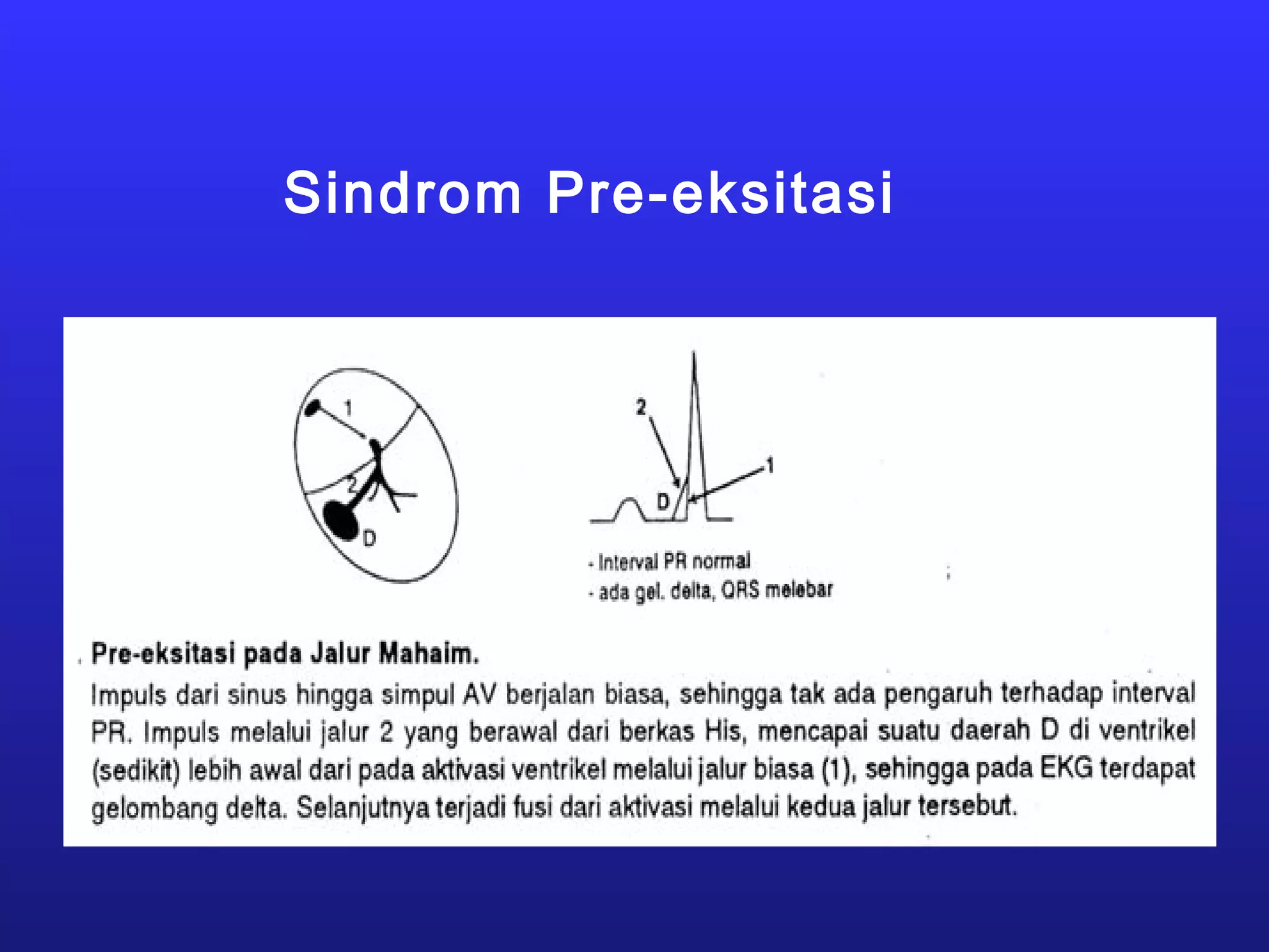 Sindrom Pre-eksitasi
 