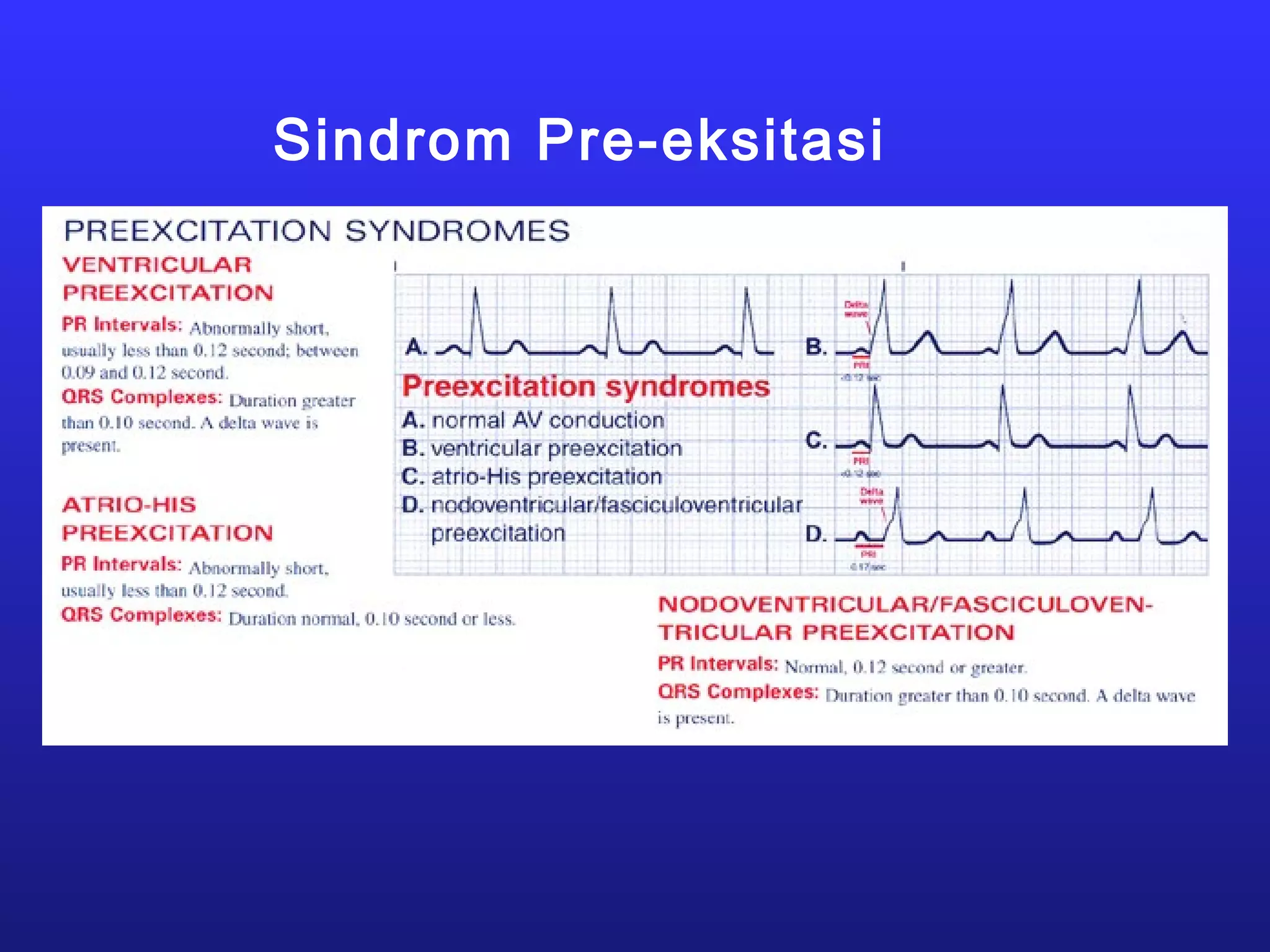 Sindrom Pre-eksitasi
 