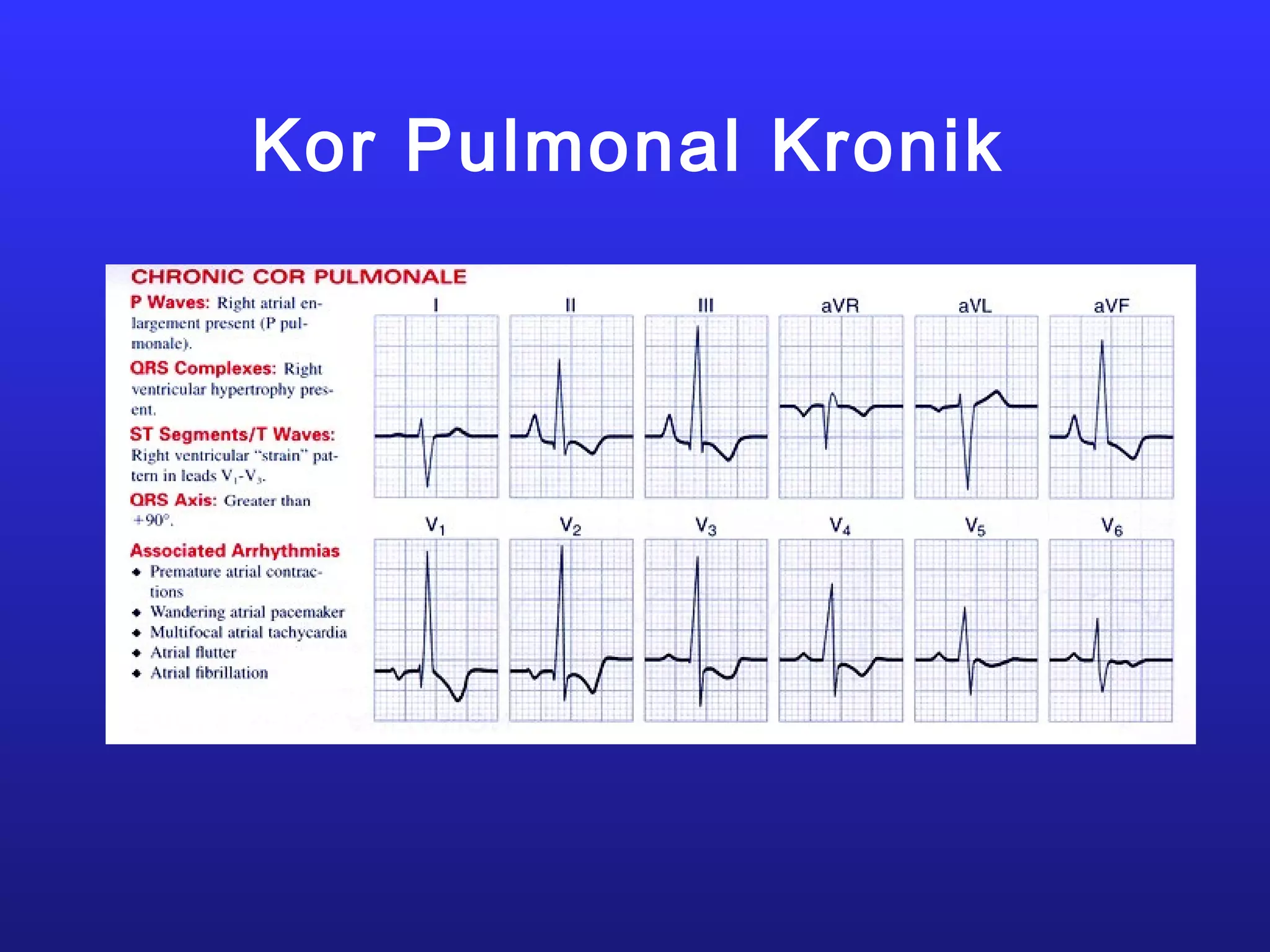 Kor Pulmonal Kronik
 