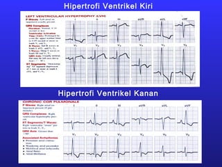 Hipertrofi Ventrikel Kiri
Hipertrofi Ventrikel Kanan
 