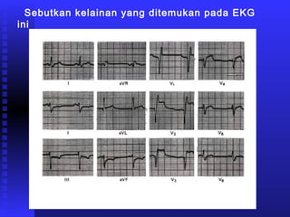 Sebutkan kelainan yang ditemukan pada EKG
ini
 