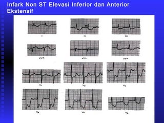 Infark Non ST Elevasi Inferior dan Anterior
Ekstensif
 