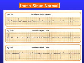 Irama Sinus Normal
 