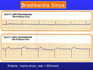 Bradikardia Sinus
Kriteria : irama sinus, rate < 60/menit
 