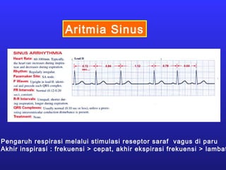 Aritmia Sinus
Pengaruh respirasi melalui stimulasi reseptor saraf vagus di paru
Akhir inspirasi : frekuensi > cepat, akhir ekspirasi frekuensi > lambat
 