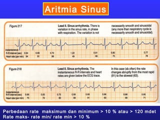 Aritmia Sinus
Perbedaan rate maksimum dan minimum > 10 % atau > 120 mdet
Rate maks- rate min/ rate min > 10 %
 