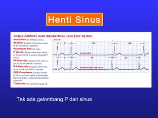 Henti Sinus
Tak ada gelombang P dari sinus
 