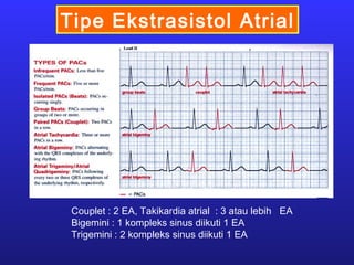 Tipe Ekstrasistol Atrial
Couplet : 2 EA, Takikardia atrial : 3 atau lebih EA
Bigemini : 1 kompleks sinus diikuti 1 EA
Trigemini : 2 kompleks sinus diikuti 1 EA
 