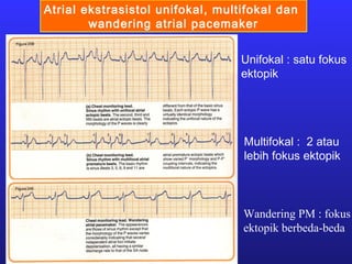 Atrial ekstrasistol unifokal, multifokal dan
wandering atrial pacemaker
Multifokal : 2 atau
lebih fokus ektopik
Unifokal : satu fokus
ektopik
Wandering PM : fokus
ektopik berbeda-beda
 
