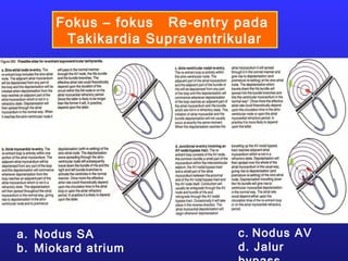 Fokus – fokus Re-entry pada
Takikardia Supraventrikular
a. Nodus SA
b. Miokard atrium
c. Nodus AV
d. Jalur
 