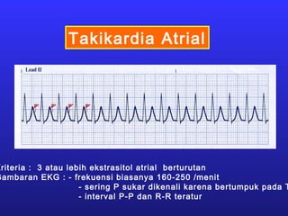 Takikardia Atrial
Kriteria : 3 atau lebih ekstrasitol atrial berturutan
Gambaran EKG : - frekuensi biasanya 160-250 /menit
- sering P sukar dikenali karena bertumpuk pada T
- interval P-P dan R-R teratur
 