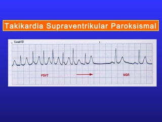 Takikardia Supraventrikular Paroksismal
 