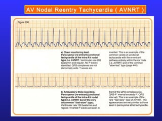 AV Nodal Reentry Tachycardia ( AVNRT )
 