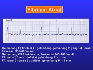 Fibrilasi Atrial
Gelombang f ( fibrilasi ) : gelombang-gelombang P yang tak teratur,
frekuensi 350-600/menit
Gelombang QRS tak teratur, frekuensi 140-200/menit
FA halus ( fine ) : defleksi gelombang P < 1 mm
FA kasar ( hoarse ) : defleksi gelombang P > 1 mm
 