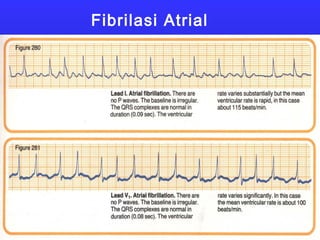 Fibrilasi Atrial
 