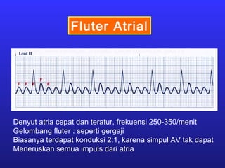 Fluter Atrial
Denyut atria cepat dan teratur, frekuensi 250-350/menit
Gelombang fluter : seperti gergaji
Biasanya terdapat konduksi 2:1, karena simpul AV tak dapat
Meneruskan semua impuls dari atria
 