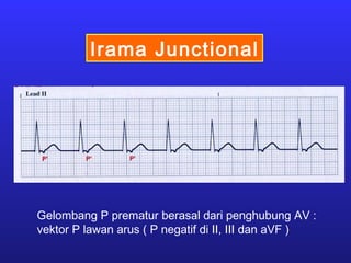 Irama Junctional
Gelombang P prematur berasal dari penghubung AV :
vektor P lawan arus ( P negatif di II, III dan aVF )
 