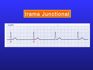 Irama Junctional
 