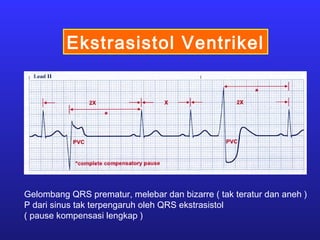Ekstrasistol Ventrikel
Gelombang QRS prematur, melebar dan bizarre ( tak teratur dan aneh )
P dari sinus tak terpengaruh oleh QRS ekstrasistol
( pause kompensasi lengkap )
 
