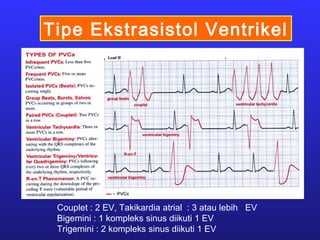 Tipe Ekstrasistol Ventrikel
Couplet : 2 EV, Takikardia atrial : 3 atau lebih EV
Bigemini : 1 kompleks sinus diikuti 1 EV
Trigemini : 2 kompleks sinus diikuti 1 EV
 