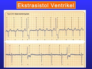 Ekstrasistol Ventrikel
 