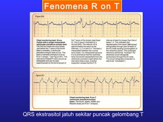 Fenomena R on T
QRS ekstrasitol jatuh sekitar puncak gelombang T
 