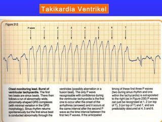 Takikardia Ventrikel
 