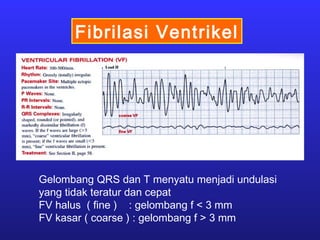 Fibrilasi Ventrikel
Gelombang QRS dan T menyatu menjadi undulasi
yang tidak teratur dan cepat
FV halus ( fine ) : gelombang f < 3 mm
FV kasar ( coarse ) : gelombang f > 3 mm
 