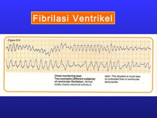 Fibrilasi Ventrikel
 