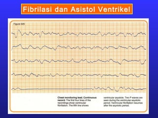 Fibrilasi dan Asistol Ventrikel
 