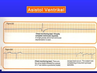 Asistol Ventrikel
 