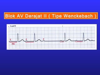Blok AV Derajat II ( Tipe Wenckebach )
 