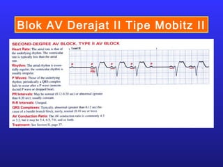Blok AV Derajat II Tipe Mobitz II
 