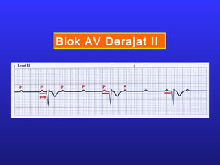 Blok AV Derajat II
 