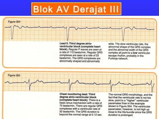 Blok AV Derajat III
 