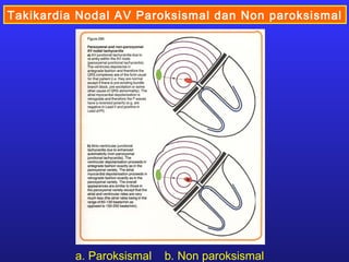 Takikardia Nodal AV Paroksismal dan Non paroksismal
a. Paroksismal b. Non paroksismal
 