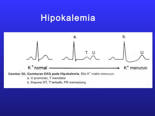 Hipokalemia
 