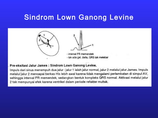 Sindrom Lown Ganong Levine
 