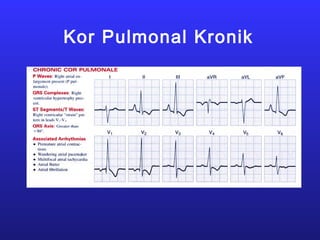 Kor Pulmonal Kronik
 